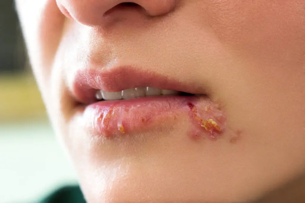 Lippen einer Frau sind übersät mit verkrusteten Bläschen, wie sie bei Lippenherpes, einer häufigen Erkrankung im Mund, auftreten.