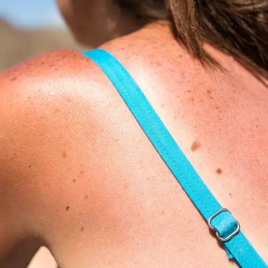 Rückenansicht einer Frau im Bikini: Das lange Sonnenbad hat einen Sonnenbrand verursacht.