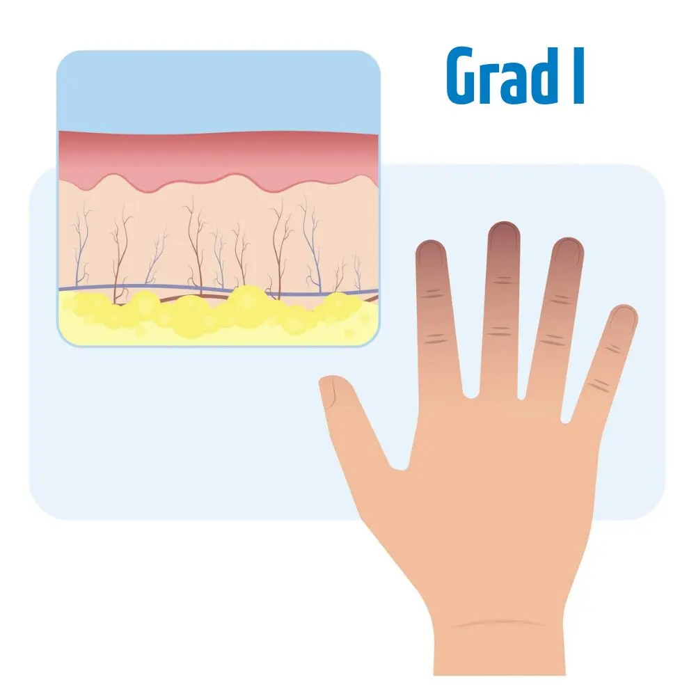 Erfrierung 1. Grades schematische Darstellung
