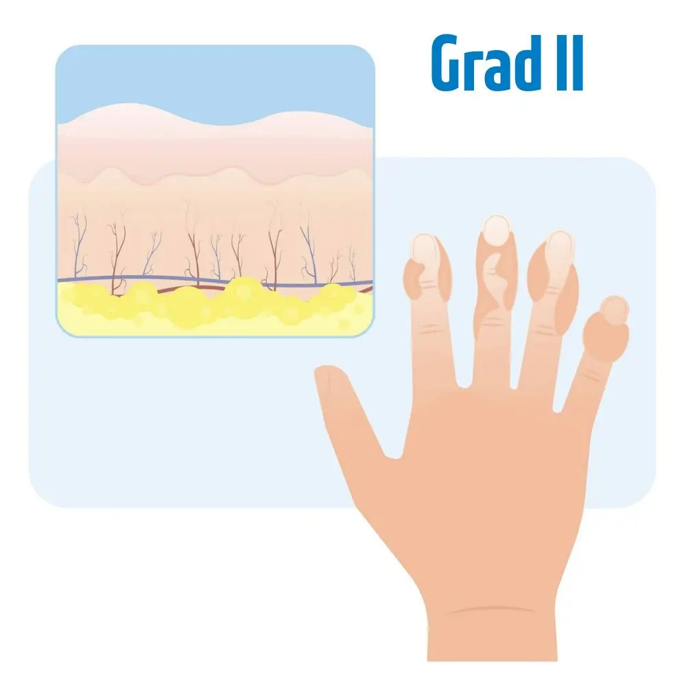 Erfrierung 2. Grades schematische Darstellung