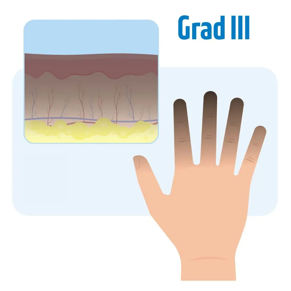 Erfrierung 3. Grades schematische Darstellung