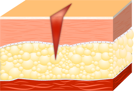 Charakteristisch für Schnittwunden sind glatte Ränder, die unterschiedlich tief in das Hautgewebe reichen können.