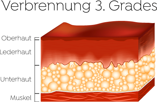 Verbrennung 3. Grades