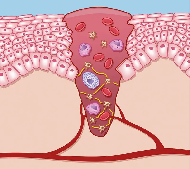 Wundheilung Exsudation