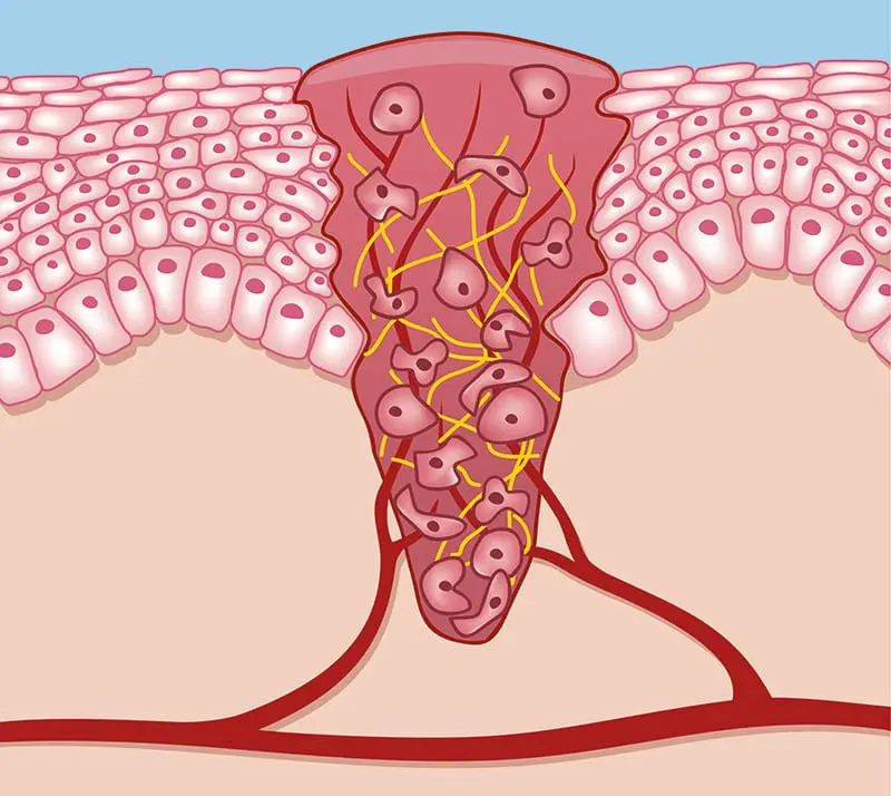 Wundheilung Granulation