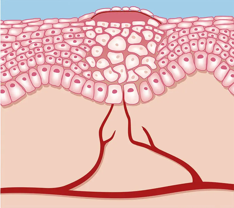 Wundheilung Epithelisierung