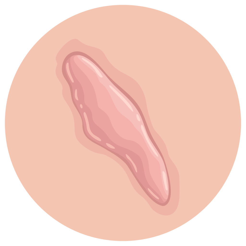 Keloide