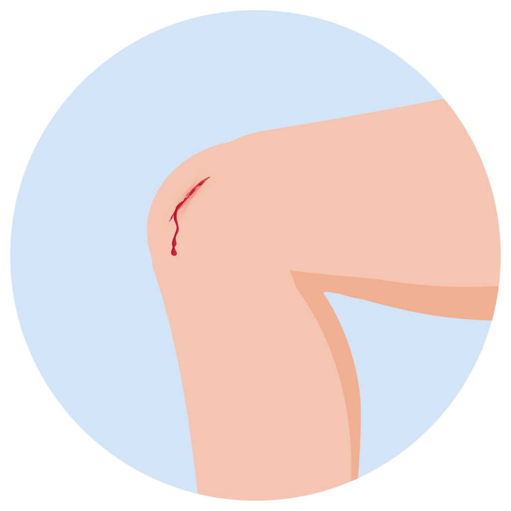 Offene Wunde am Knie, bei der die Blutung gestoppt werden muss.