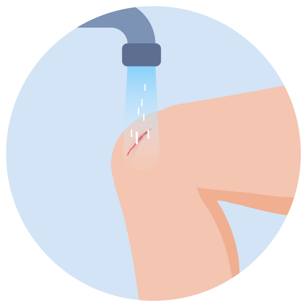 Knie wird unter fließendem Wasser gereinigt, um Verunreinigungen und Blut zu entfernen.