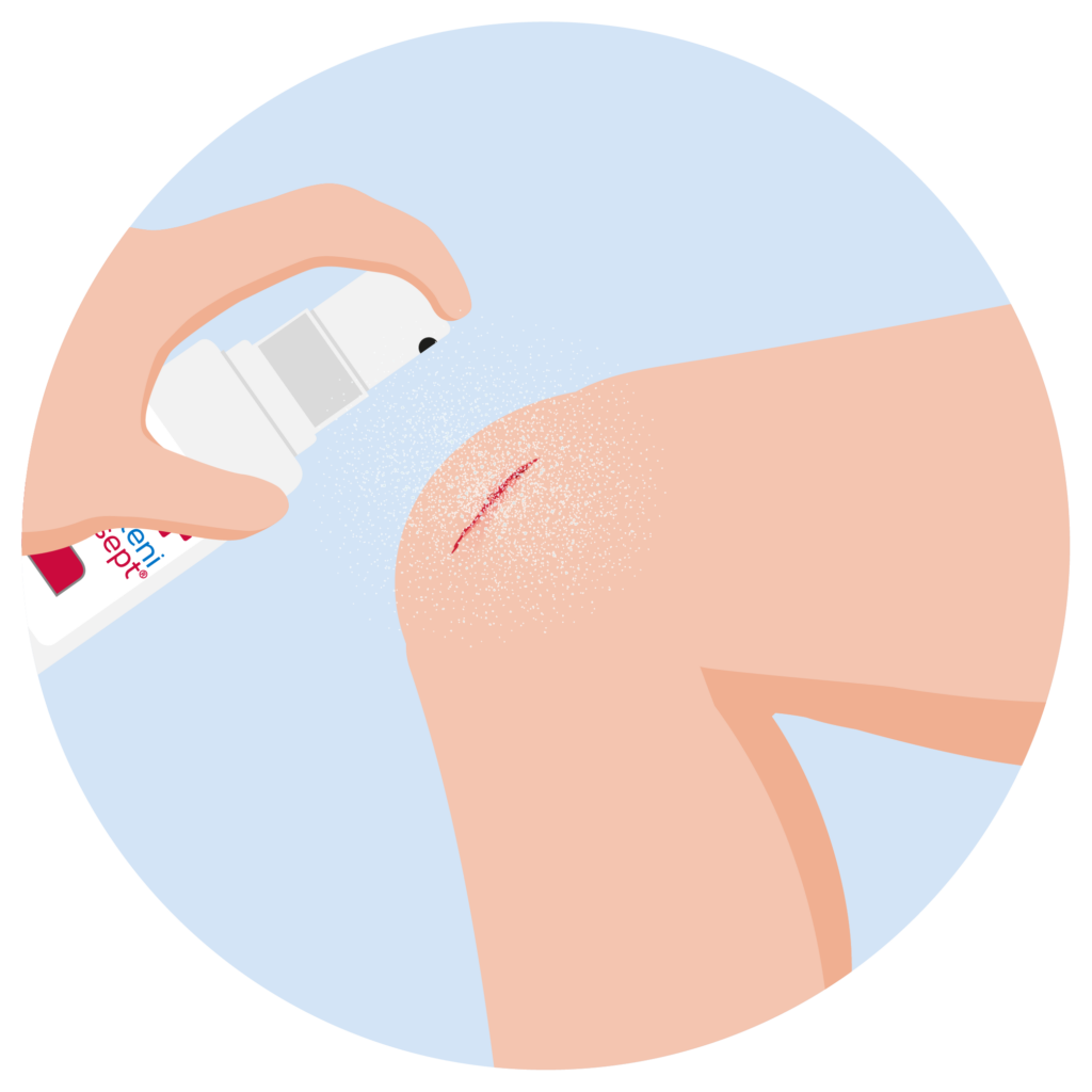 Knie wird mit octenisept® Wund-Desinfektionsspray desinfiziert, um Keime abzutöten und Entzündungen vorzubeugen